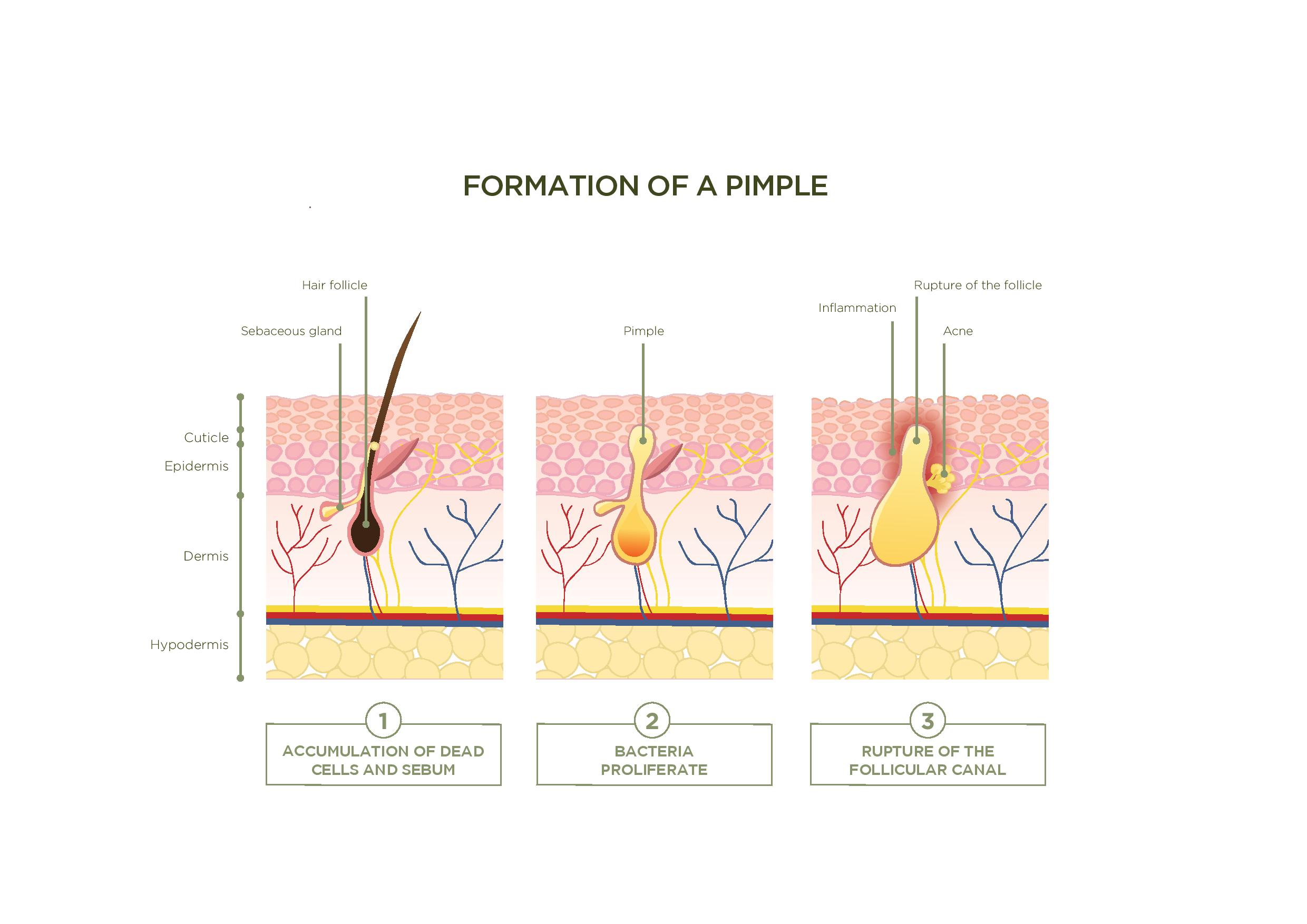 The Formation Of a Pimple: Did you Know That Pimples Take 2 Weeks to Form?